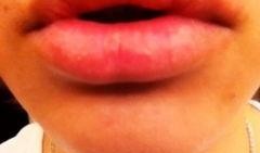 吃蜜瓜嘴肿,甜蜜诱惑下的意外“肿”态